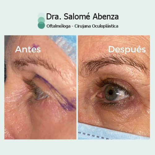Blefaroplastia superior bilateral antes de la cirugía, se puede observar el exceso de piel encima de las pestañas. A los 6 meses de la cirugía se observa como se ha despejado la mirada con un resultado natural y la cicatriz casi imperceptible en el párpado superior. Blefaroplastia superior bilateral antes de la cirugía, se puede observar el exceso de piel encima de las pestañas. A los 6 meses de la cirugía se observa como se ha despejado la mirada con un resultado natural y la cicatriz casi imperceptible en el párpado superior.
