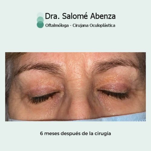 Dorctora Salomé Abenza Blefaroplastia superior bilateral antes de la cirugía, se puede observar el exceso de piel encima de las pestañas.