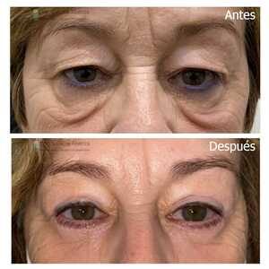 Blefaroplastia superior e inferior transconjuntival  y cantopexia bilateral