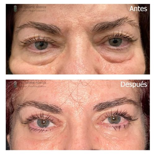 Blefaroplastia superior e inferior trasnconjuntival con cantopexia bilateral Doctora Salomé Abenza - Blefaroplastia superior e inferior trasnconjuntival con cantopexia bilateral