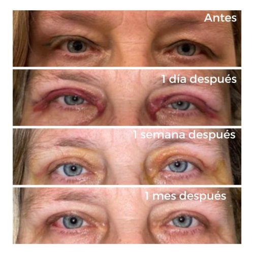 Evolución de cirugía de blefaroplastia superior. Postoperatorio inmediato al termina la cirugía. Aquí podemos ver la progresión de la recuperación desde el día siguiente a la operación hasta un mes después.