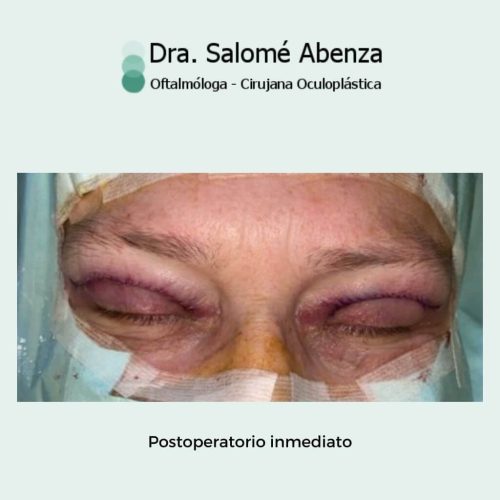 Postoperatorio inmediato al termina la cirugía. Esta innovación permite una recuperación mucho más rápida con un resultado excepcional.