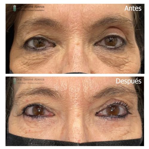Blefaroplastia superior y blefaroplastia inferior con cantopexia bilateral antes y después mirada al frente. Blefaroplastia superior y blefaroplastia inferior con cantopexia bilateral antes y después mirada al frente - Cirugía realizada por la Doctora Salomé Abenza