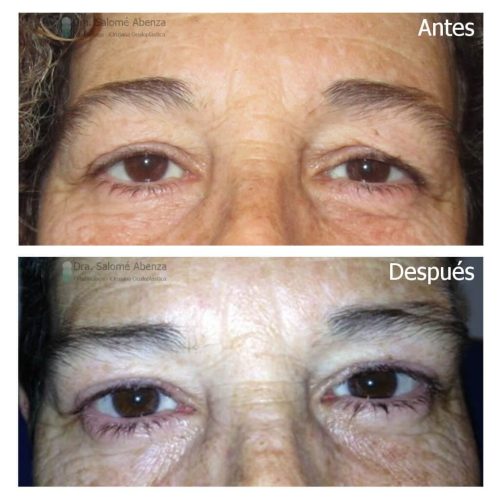 Blefaroplastia superior y cejaplastia temporal directa bilateral
