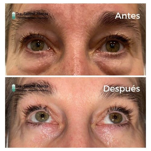 Blefaroplastia superior e inferior transconjuntival con cantopexia bilateral, antes de la operación de párpados y a los 2 meses de la cirugía. Detalle de resultado con mirada de la paciente hacia arriba.