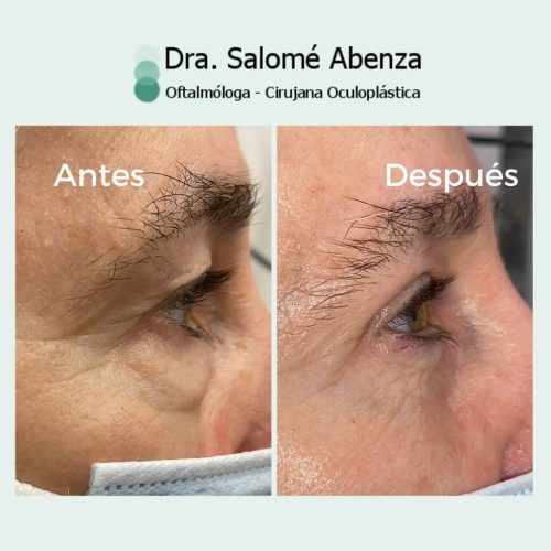 Blefaroplastia superior e inferior transconjuntival con cantopexia bilateral, antes de la operación de párpados y a los 2 meses de la cirugía. Detalle de resultado vista de perfil derecho.