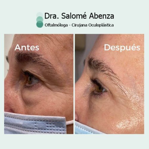 Blefaroplastia superior e inferior transconjuntival con cantopexia bilateral, antes de la operación de párpados y a los 2 meses de la cirugía. Detalle de resultado vista de perfil izquierdo de la paciente.