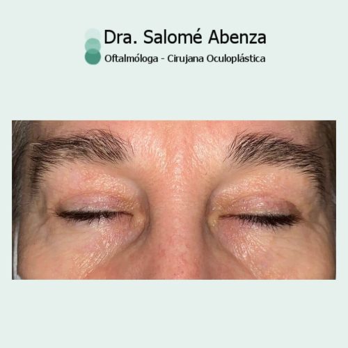 Blefaroplastia superior e inferior transconjuntival con cantopexia bilateral, a los 2 meses de la cirugía de párpados. Detalle de resultado con mirada de la paciente de frente con los ojos cerrados.