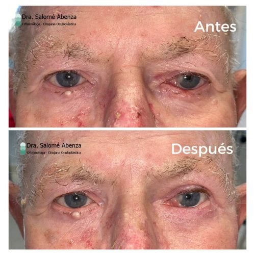 Extirpación de Carcinoma basocelular en párpado inferior izquierdo y reconstrucción mediante injerto tarsoconjuntival del parpado superior y colgajo de Tripier.