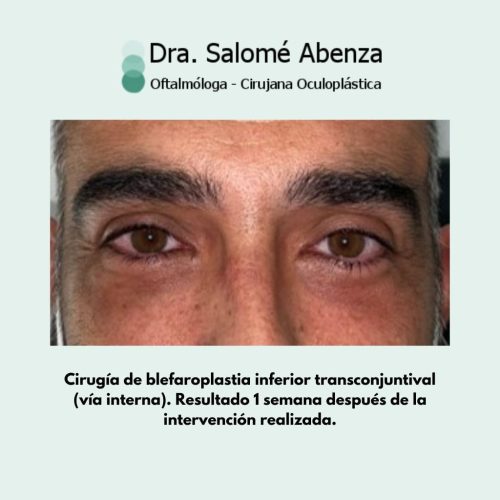 Blefaroplastia inferior transconjuntival (vía interna). Una semana después de la intervención.
