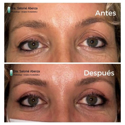 Cirugía, realizada por la Dra. Salomé Abenza en Murcia, de blefaroplastia superior antes y al mes de la intervención. 