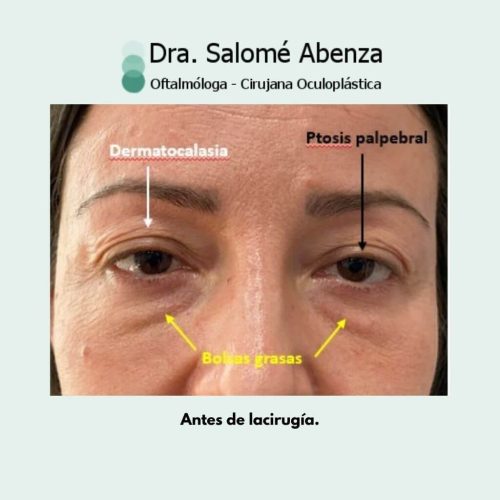Cirugía de ptosis palpebral superior mediante reinsercion de aponeurosis vía anterior, blefaroplastia superior e inferior transconjuntival con cantopexia bilateral a los 2 meses de la intervención, señalando las zonas a intervenir.