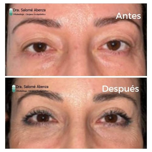 Cirugía de ptosis palpebral superior mediante reinsercion de aponeurosis vía anterior y blefaroplastia superior e inferior transconjuntival con cantopexia bilateral antes y después a los 2 meses de la intervención.