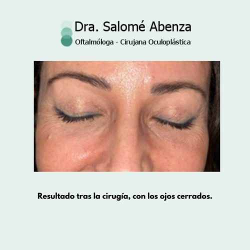 Cirugía de ptosis palpebral superior mediante reinsercion de aponeurosis vía anterior, blefaroplastia superior e inferior transconjuntival con cantopexia bilateral a los 2 meses de la intervención. Resultado final con los ojos cerrados.