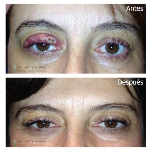 Extirpación de chalacion múltiples en párpado superior derecho. Extirpación de chalacion múltiples en párpado superior derecho.