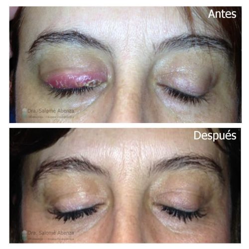 Extirpación de chalacion múltiples en párpado superior derecho. Extirpación de chalacion múltiples en párpado superior derecho.