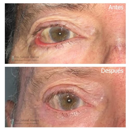 Ectropion cicatricial del párpado inferior derecho tratado mediante injerto miocutáneo de Tripier del párpado superior y cantoplastia.