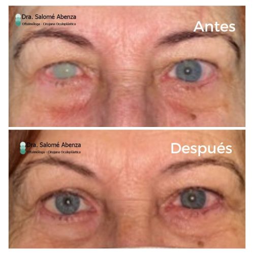 Cirugía de evisceracion ojo derecho tras 3 meses, con prótesis externa cosmética adaptada.