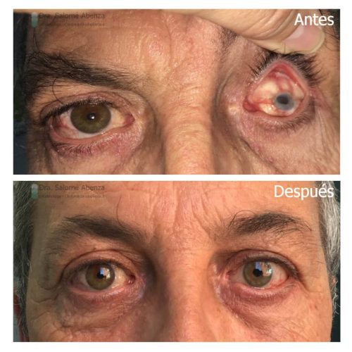 Evisceración ojo izquierdo por traumatismo, prótesis externa cosmética definitiva. Evisceración ojo izquierdo por traumatismo, prótesis externa cosmética definitiva.