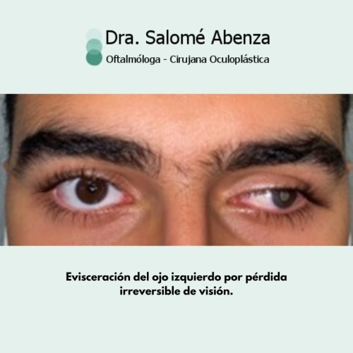 Cirugía de evisceración realizada por la Dorctora Salomé Abenza, en Murcia Evisceración del ojo izquierdo por pérdida irreversible de visión; antes de la cirugía.