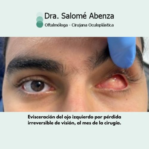 Cirugía de evisceración realizada por la Dorctora Salomé Abenza, en Murcia Evisceración del ojo izquierdo por pérdida irreversible de visión; al mes de la cirugía.