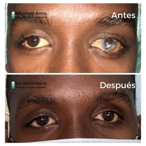 Paciente con ojo izquierdo ciego y doloroso al que se realizó evisceración con implante orbitario. Imágen tras colocación de prótesis cosmética definitiva. 