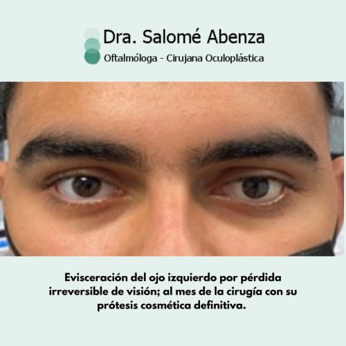 Cirugía de evisceración realizada por la Dorctora Salomé Abenza, en Murcia Evisceración del ojo izquierdo por pérdida irreversible de visión; al mes de la cirugía con su prótesis cosmética definitiva.