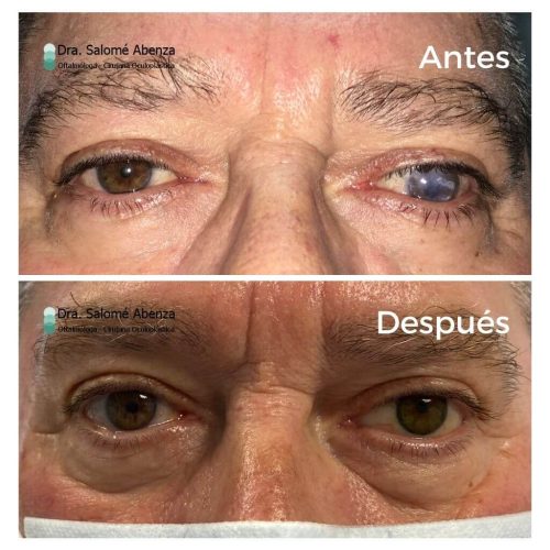 Paciente con ceguera OI tras múltiples cirugías, antes y después de evisceración en ojo izquierdo con implante orbitario y prótesis externa cosmética, estable tras 2 años.