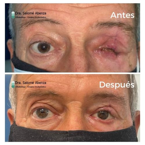 Doctora Salomé Abenza Oftalmóloga - Especialista en blefaroplastia y cirugía de párpados. Evisceración y reconstrucción de ojo izquierdo causado por trauma con una radial, antes y después de la operación.