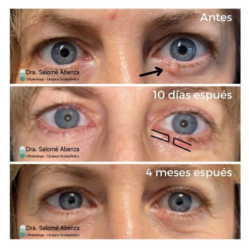 Extirpación de carcinoma basocelular en párpado inferior izquierdo y reconstrucción mediante colgajo en H a los 10 días y a los 4 meses.