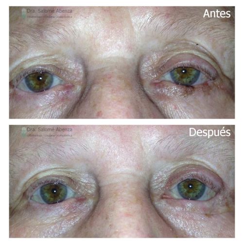 Extirpación de melanoma en párpado inferior izquierdo y reconstrucción mediante injerto tarsoconjuntival, colgajo de Tripier y tira perióstica. Extirpación de melanoma en párpado inferior izquierdo y reconstrucción mediante injerto tarsoconjuntival, colgajo de Tripier y tira perióstica.