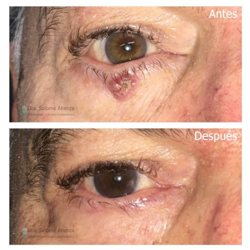 Extirpación y reconstrucción tumor párpado antes y después de la operación. Extirpación y reconstrucción tumor párpado antes y después de la operación.