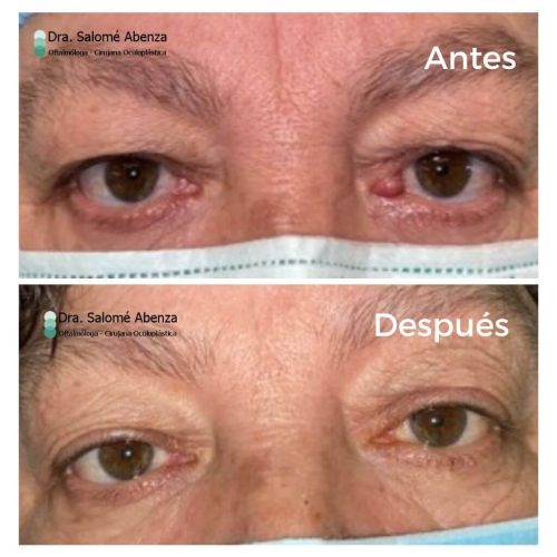 Tumor benigno en canto interno izquierdo (nevus) antes y después a los 3 meses de la extirpación y reconstrucción de vía lagrimal. Tumor benigno en canto interno izquierdo (nevus) antes y después a los 3 meses de la extirpación y reconstrucción de vía lagrimal.