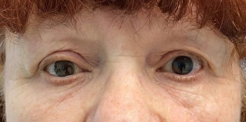 Paciente con prótesis en ojo derecho Paciente con prótesis en ojo derecho