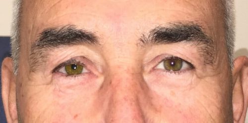 Paciente con prótesis en ojo derecho Paciente con prótesis en ojo derecho