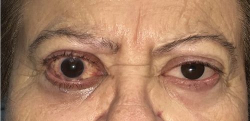 Paciente con prótesis en ojo izquierdo Paciente con prótesis en ojo izquierdo