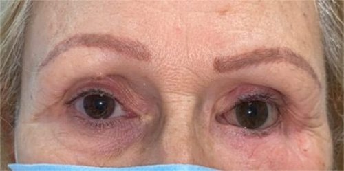 Paciente con prótesis en ojo izquierdo Paciente con prótesis en ojo izquierdo