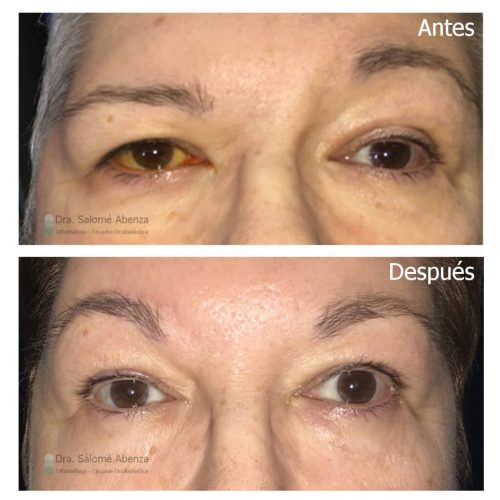 Parálisis facial derecha (ptosis de ceja y lagoftalmos) antes de la operación y después de cejaplastia directa derecha y pesa de oro en el párpado superior derecho con oclusión completa. Parálisis facial derecha (ptosis de ceja y lagoftalmos) antes de la operación y después de cejaplastia directa derecha y pesa de oro en el párpado superior derecho con oclusión completa.