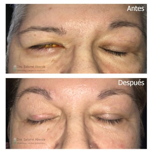 Parálisis facial derecha (ptosis de ceja y lagoftalmos) antes de la operación y después de cejaplastia directa derecha y pesa de oro en el párpado superior derecho con oclusión completa. Parálisis facial antes y después ojos cerrados