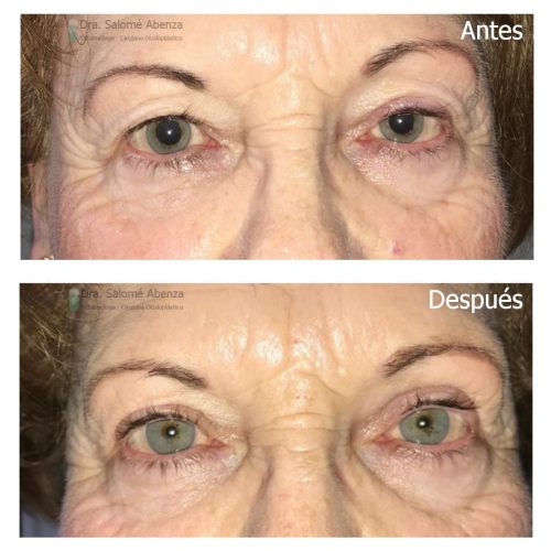 Ptosis aponeurótica izquierda tratada mediante reinserción de aponeurosis del músculo elevador del párpado vía anterior y blefaroplastia bilateral. Ptosis aponeurótica izquierda tratada mediante reinserción de aponeurosis del músculo elevador del párpado vía anterior y blefaroplastia bilateral.