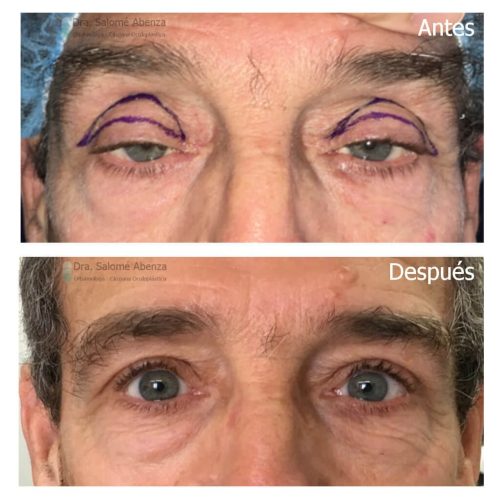 Ptosis aponeurótica bilateral tratada mediante reinserción de aponeurosis del músculo elevador del párpado vía anterior y blefaroplastia bilateral.