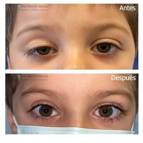 Ptosis miogénica congénita derecha tratada mediante resección del músculo elevador del párpado vía anterior. Ptosis miogénica congénita derecha tratada mediante resección del músculo elevador del párpado vía anterior.