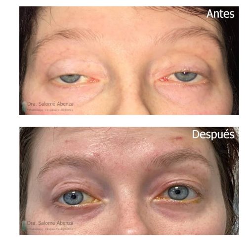 Ptosis miogénica adquirida bilateral por Oftalmoplegia Externa Crónica Progresiva dentro del Síndrome de Kearn-Sayre, tratada mediante suspensión frontal con silicona. 