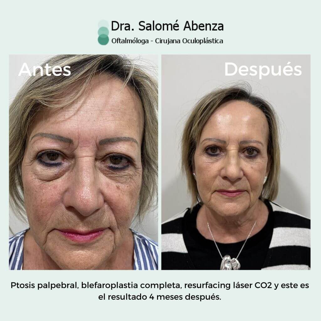 ptosis palpebral y blefaroplastia completa