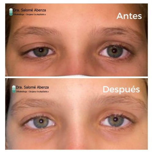 Ptosis palpebral congénita: Círugía de resección de aponeurosis vía anterior derecha antes y después a los 6 meses de la intervención. Ptosis palpebral congénita: Círugía de resección de aponeurosis vía anterior derecha antes y después a los 6 meses de la intervención.