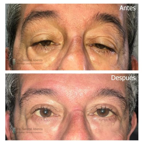 Ptosis miogénica adquirida bilateral por Distrofia oculofaringea tratada mediante resección del músculo elevador del párpado vía anterior.