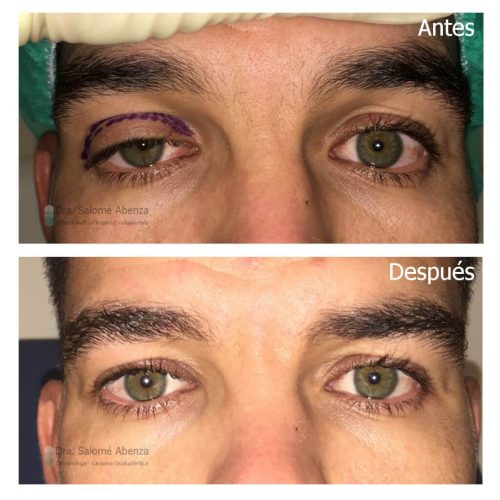 Ptosis traumática derecha tratada mediante resección del músculo elevador del párpado vía anterior y mínima blefaroplastia. Ptosis traumática derecha tratada mediante resección del músculo elevador del párpado vía anterior y mínima blefaroplastia.