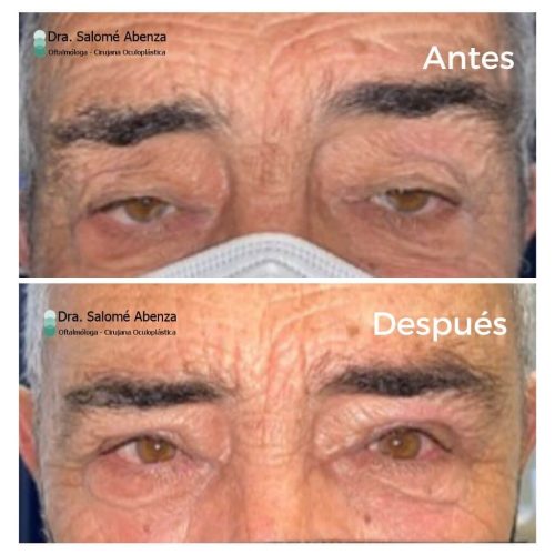 Cirugía de ptosis palpebral mediante reinserción de aponeurosis del músculo elevador del párpado y blefaroplastia superior, al mes de la intervención