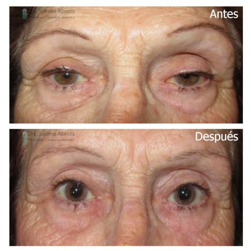 Doctora Salomé Abenza - Reinserción de aponeurosis del elevador bilateral antes y después de la cirugía