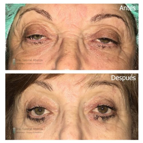 Ptosis miogénica adquirida bilateral por Miastenia Gravis no respondedora a tratamiento médico, tratada mediante técnica de suspensión frontal con fascia lata. Ptosis miogénica adquirida bilateral por Miastenia Gravis no respondedora a tratamiento médico, tratada mediante técnica de suspensión frontal con fascia lata.
